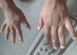 What’s the remedy for warts