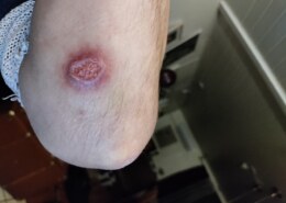 What causes skin issue?